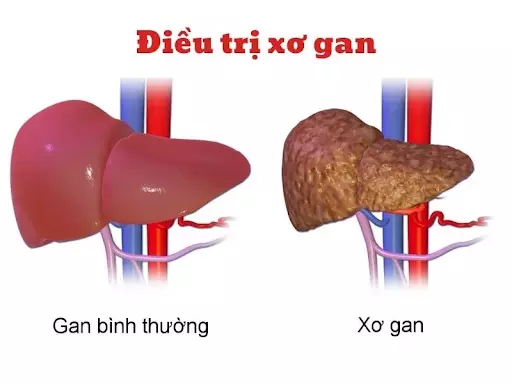 Các phương pháp điều trị xơ gan hiệu quả nhất hiện nay